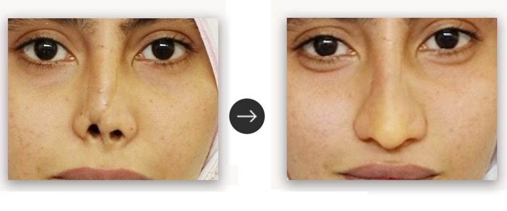 Custom Facial Prosthetics | Anaplastology